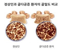 기침 후 허리 뜨끔? 놓치면 안 될 ‘척추압박골절’ 신호일 수도